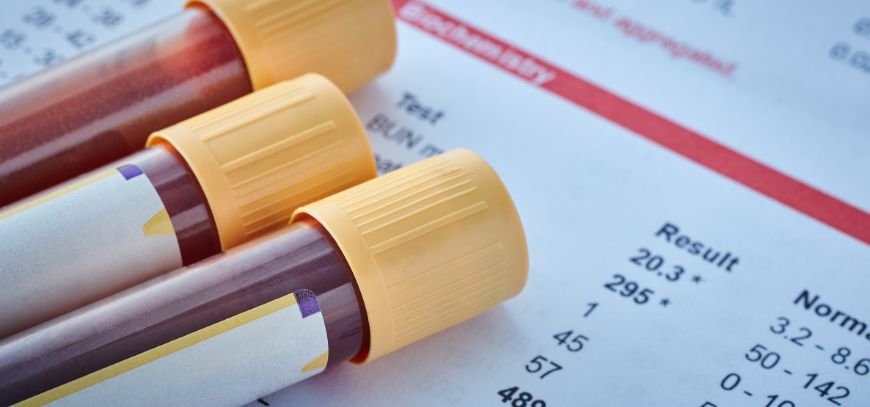 vitamin blood analysis orange county ca